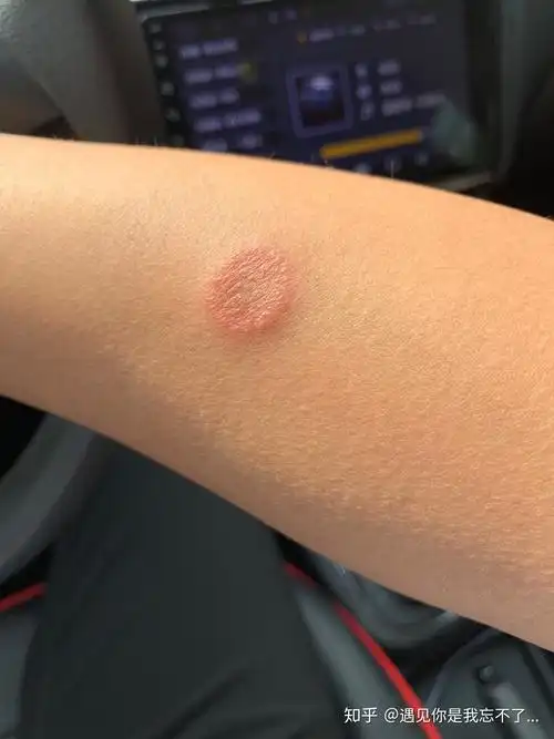 人得了猫癣发痒怎么办