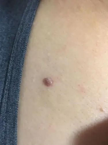 请问这是痣么 是好是坏