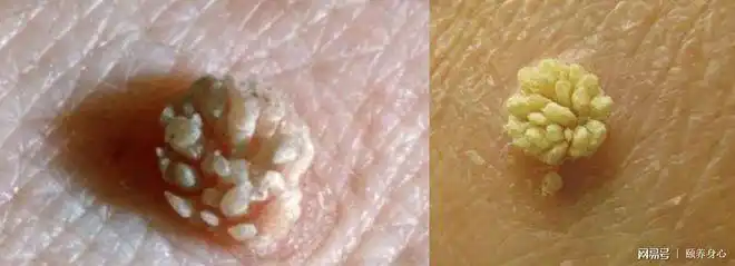 感染hpv男女有疣物1个法子除去它
