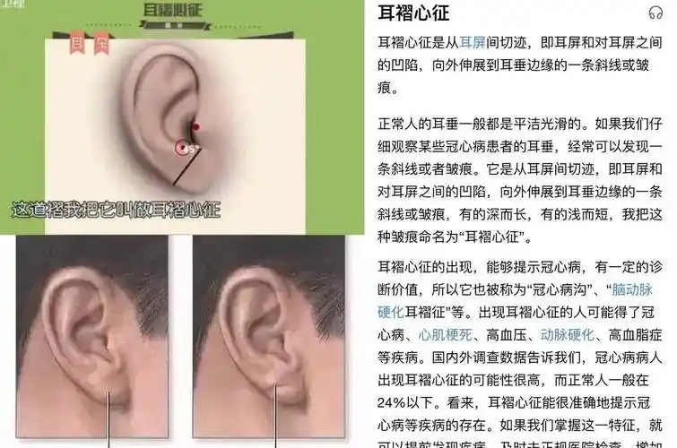 她的耳垂上有个褶皱,而这其实是一个缺陷,专业术语称为"耳褶心征",而