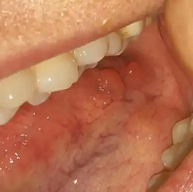 有慢性咽炎多年.