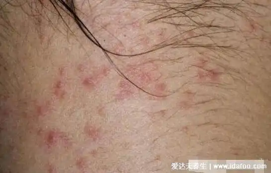 艾滋病全身皮肤症状图片,警惕多种皮疹小红点水疱
