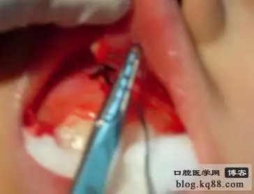 一例唇系带矫正术