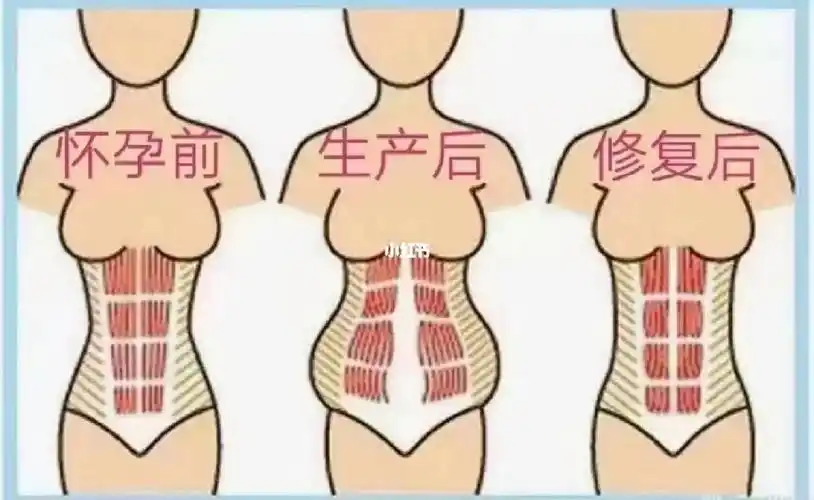 腹直肌分离严重性自己对比一下