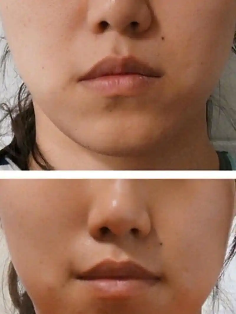 嘴角下垂看起来严肃或沮丧,容易散发出"生人勿近"的_圈子-新氧美容