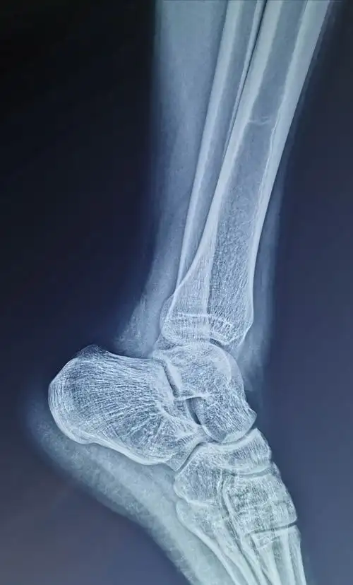 一例腓骨下极撕脱骨折 - 美篇