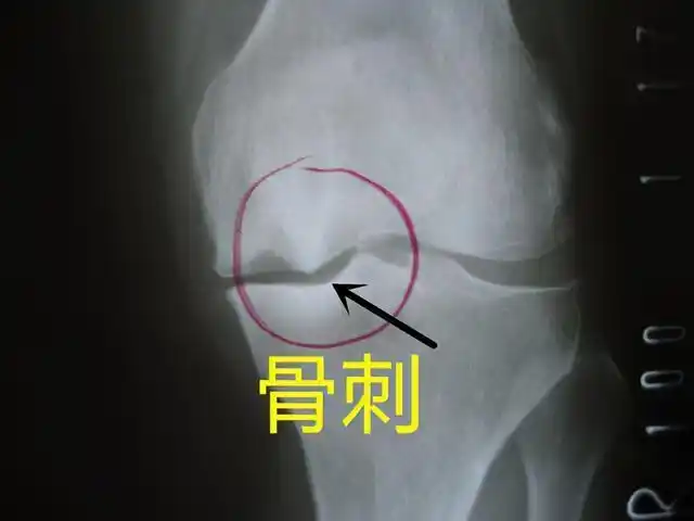 67一,什么是骨刺?