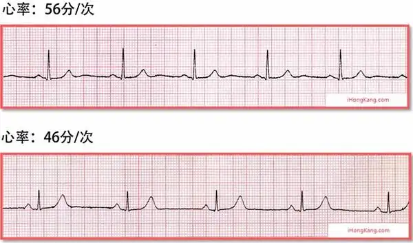 解读心电图报告系列|窦性心动过缓和窦性心动过速的"秘密"