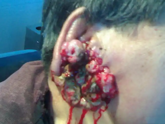 一期梅毒图片——肛门部硬下疳图片_有来医生