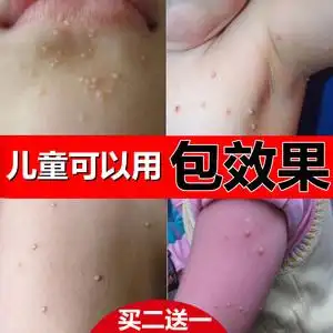 传染性软疣儿童病毒性去软疣膏大人瘊子去除药膏工具治疗水猴子药