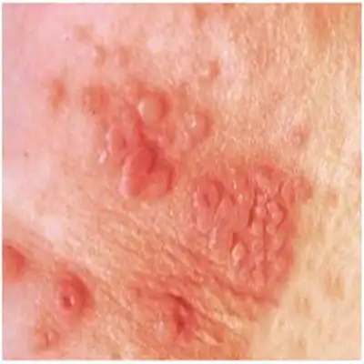 性病的早期症状图片 (48)