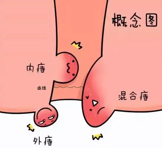 1药网上厕所时发现肛门外多了个小肉球一查竟是痔疮惹的祸