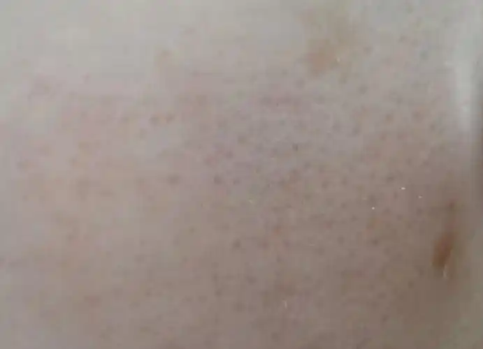 毛孔粗大到底应该怎么解决