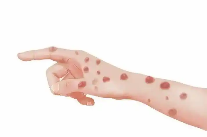 科普| 感染了梅毒,身体或会出现3个异常,尽量别忽视了!