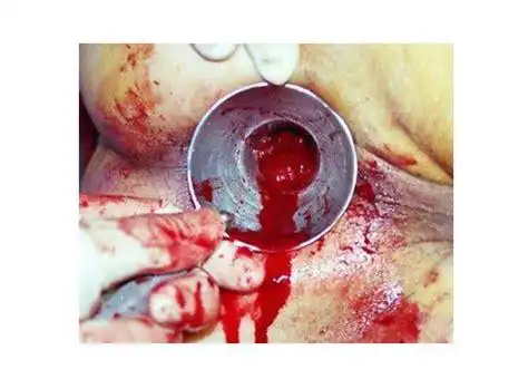 痔疮长啥样子图片外痔疮是什么样子图片2022已更新今日更新