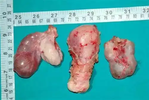 子宫囊肿为什么尿频