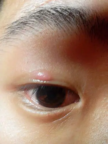 眼皮上长了个痘痘,一周下不去,不痛不痒