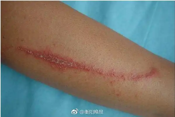 这种虫子千万别拍!毒液可能致皮肤溃烂!