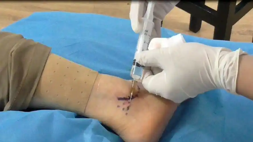 踝关节区银质针|温针灸|内热针临床操作-学习视频教程-腾讯课堂