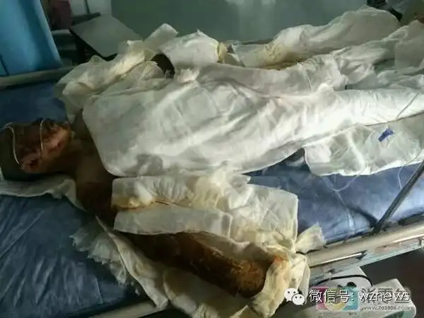 温州一花季少女全身58面积的烧伤惨不忍睹