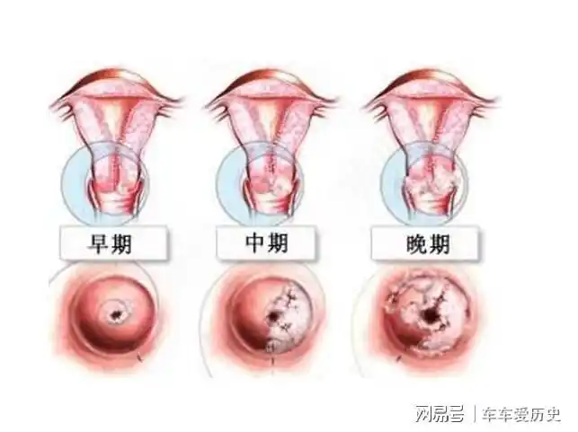 hpv病毒才是宫颈病变的刽子手不想病变坚持3种行为是正道