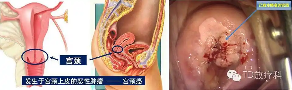 我会得宫颈癌吗?