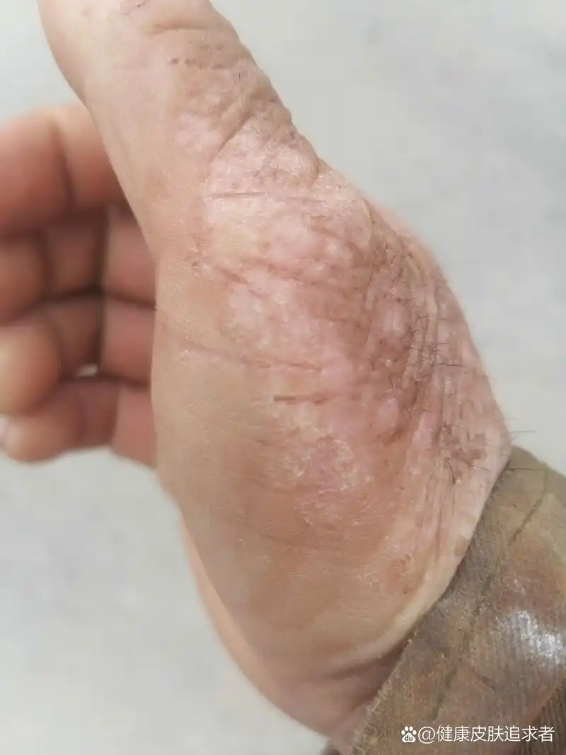 关爱皮肤健康 手部皮肤脂溢性皮炎就是痒痒的