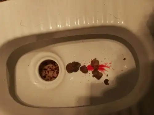 大便出血求解决_百度宝宝知道