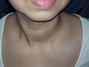 大脖子病和甲状腺结节有什么区别