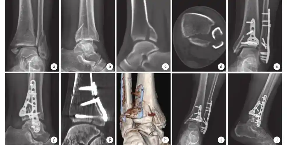经后外侧入路钢板和螺钉内固定治疗后踝骨折疗效比较