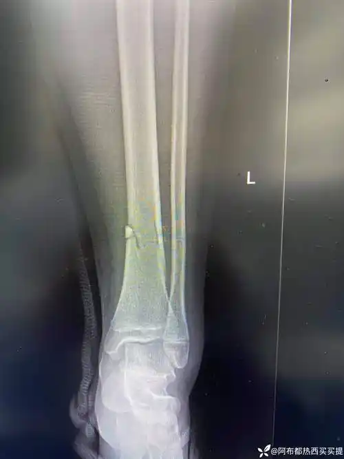 大龄超重儿童胫骨骨折