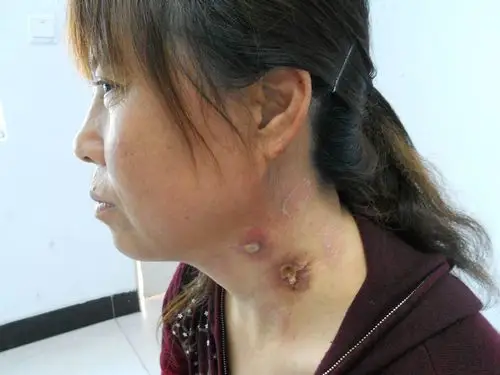 ██ 淋巴结核患者治疗病例跟踪之二█ █