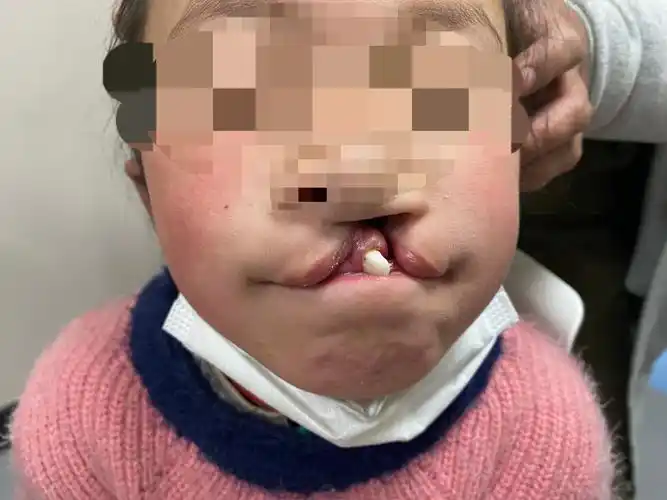 焕然医新丨省二院烧伤整形美容科为患儿成功修复唇腭裂