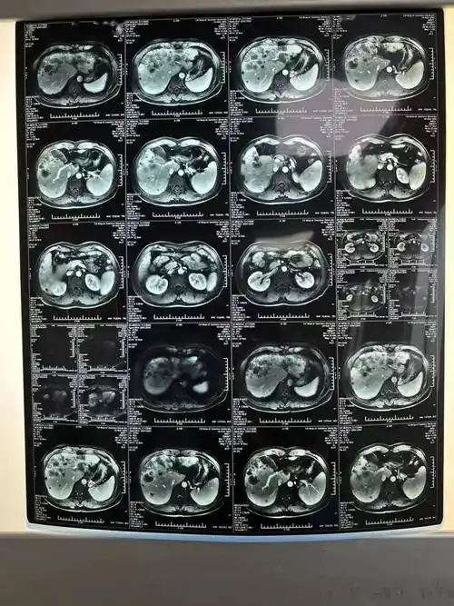 杏林春暖我院肿瘤科收到一胰腺癌多发转移患者的感谢锦旗