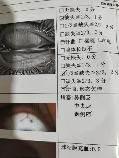 问问刘浩存嘛我这干眼症严重吗