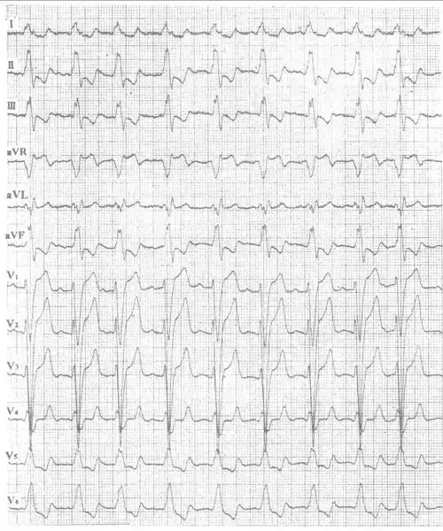 一,左室肥厚-12导联心电图同步诊断学-医学