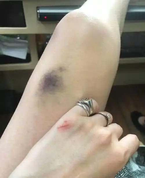 田朴珺膝盖处现淤青自爆伤痕累累惹人心疼网友喊话王石