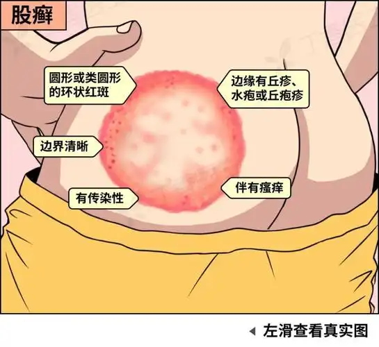 图片来源:丁香医生设计团队 & 参考文献体癣/股癣的治疗以局部抗真菌