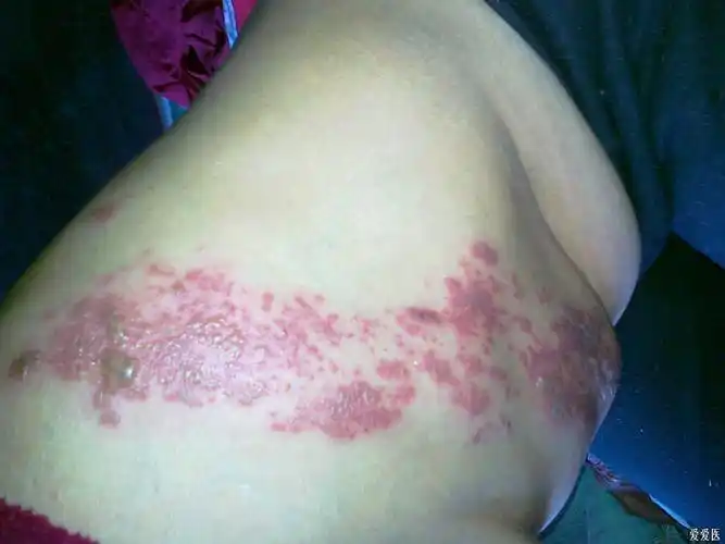 带状疱疹怎么治啊