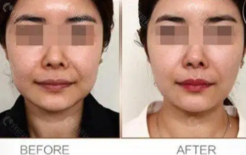 面部拉皮前后对比图