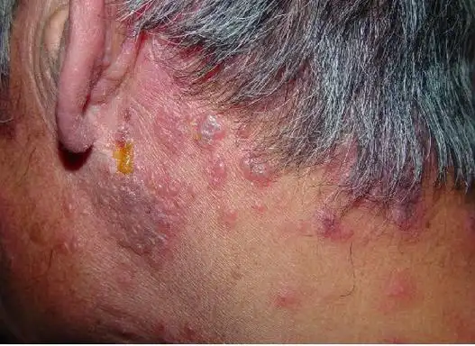 带状疱疹涂药膏就可以治好吗?