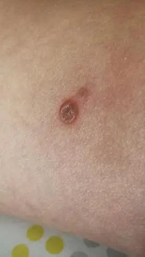 大腿内侧长了个痘痘,这是啥?怎么治?