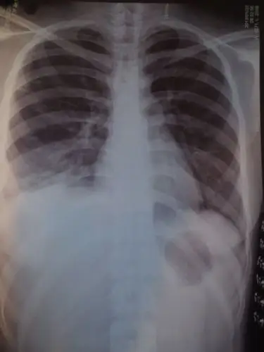 今天拍了片后说 是肺炎 但是我不咳嗽 就是有点流鼻涕 有时候呼吸超级