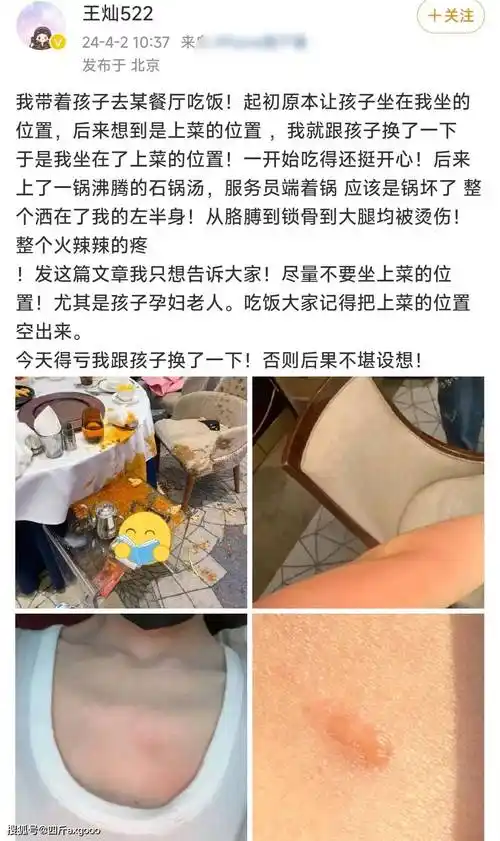 原创杜淳老婆王灿意外被烫伤锁骨胳膊大腿均受伤庆幸和孩子换位置