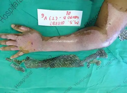 医生治烧伤用"鱼皮",啥药也不用,愈合快效果好