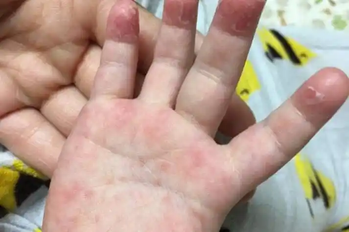 小孩子手上有红点图片_有来医生