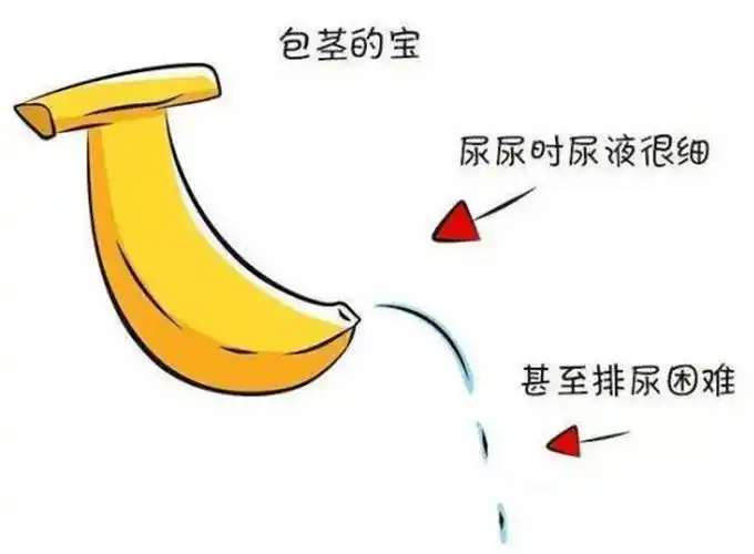 74 包茎是包皮口狭窄,使包皮不能翻转显露阴茎头,排尿时尿流细如线