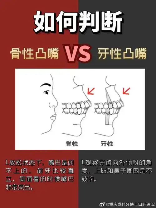 如何判断骨性嘴突还是牙性嘴突?