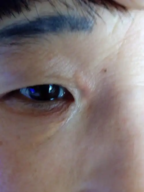 美容外科双上下睑睑黄瘤求治疗方法