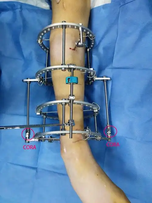 or切开复位钢板固定?复查x线片可见胫骨断端向后方成角